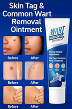 New Wart Remover Ointment cream PACK OF 2