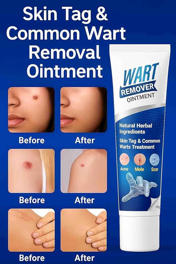 New Wart Remover Ointment cream PACK OF 2